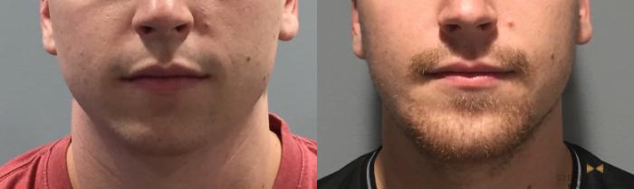 Before & After Chin Implant Case 91 View #3 View in Fort Worth & Arlington, Texas