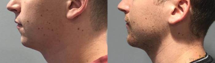 Before & After Chin Implant Case 91 View #4 View in Fort Worth & Arlington, Texas