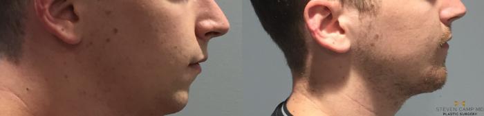 Before & After Chin Implant Case 91 View #5 View in Fort Worth & Arlington, Texas