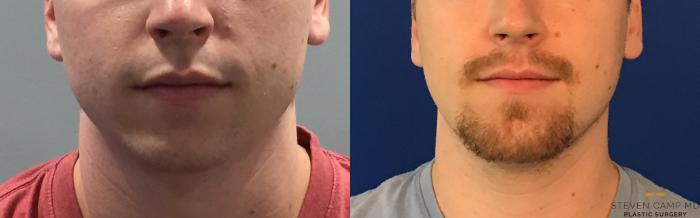 Before & After Chin Implant Case 91 View #6 View in Fort Worth & Arlington, Texas