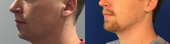 Before & After Chin Implant Case 91 View #7 View in Fort Worth & Arlington, Texas