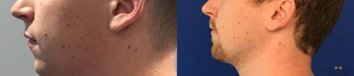 Before & After Chin Implant Case 91 View #8 View in Fort Worth & Arlington, Texas