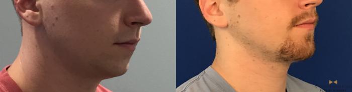 Before & After Chin Implant Case 91 View #9 View in Fort Worth & Arlington, Texas