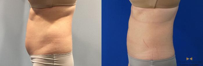 Before & After CoolSculpting Case 148 View #1 View in Fort Worth, Texas