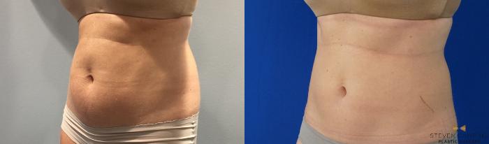 Before & After CoolSculpting Case 148 View #2 View in Fort Worth, Texas