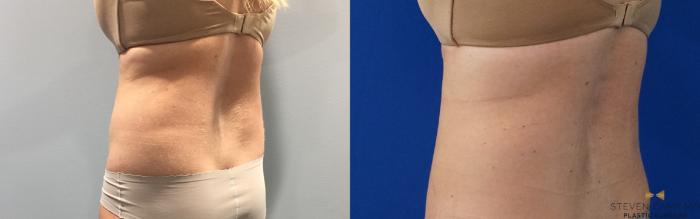 Before & After CoolSculpting Case 148 View #4 View in Fort Worth, Texas
