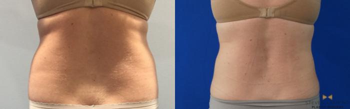 Before & After CoolSculpting Case 148 View #5 View in Fort Worth, Texas