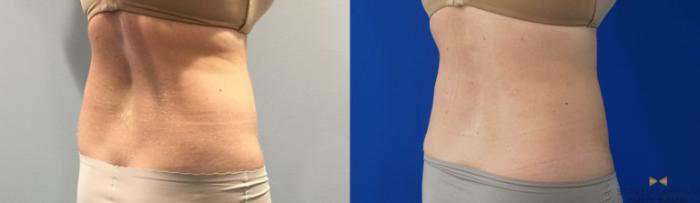 Before & After CoolSculpting Case 148 View #6 View in Fort Worth, Texas