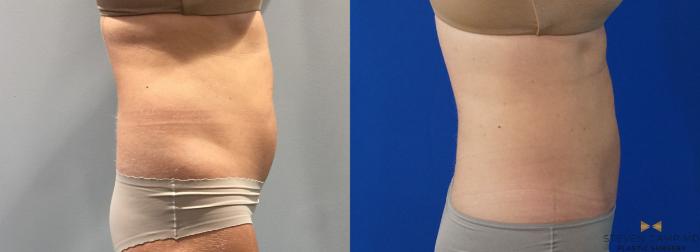 Before & After CoolSculpting Case 148 View #7 View in Fort Worth, Texas