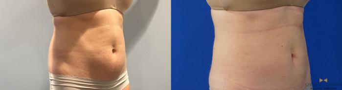 Before & After CoolSculpting Case 148 View #8 View in Fort Worth, Texas