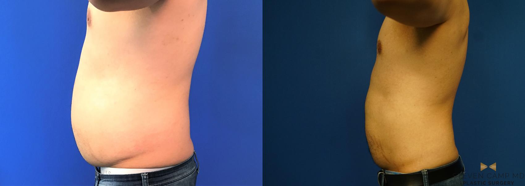 CoolSculpting Before & After Photo | Fort Worth, Texas | Steven Camp MD Plastic Surgery