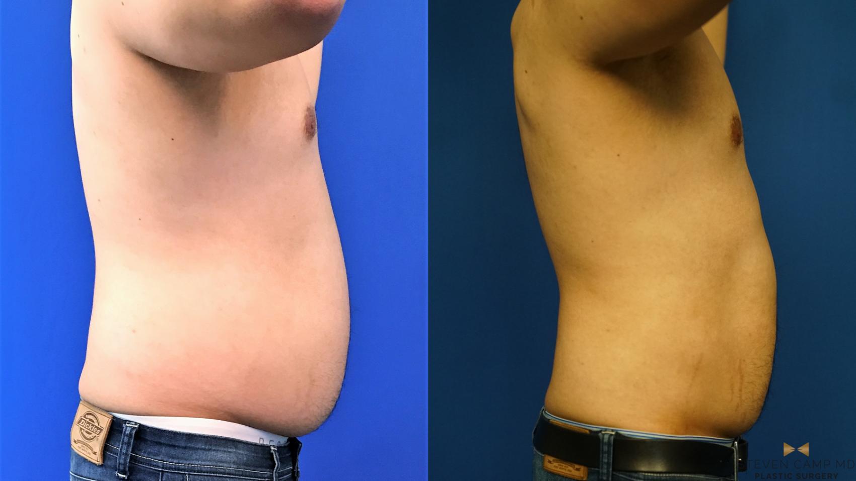 CoolSculpting Before & After Photo | Fort Worth, Texas | Steven Camp MD Plastic Surgery