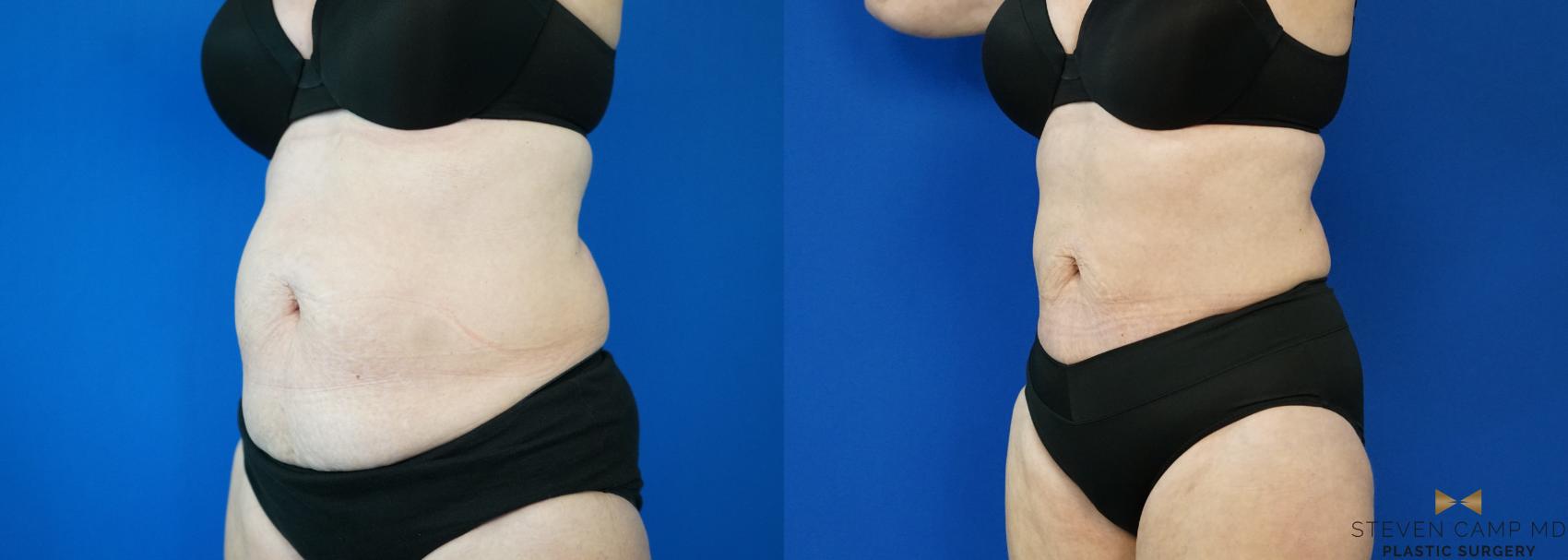 Before & After CoolSculpting Case 197 View #1 View in Fort Worth, Texas