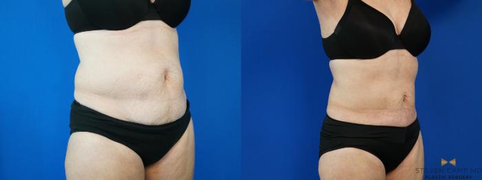 Before & After CoolSculpting Case 197 View #2 View in Fort Worth, Texas