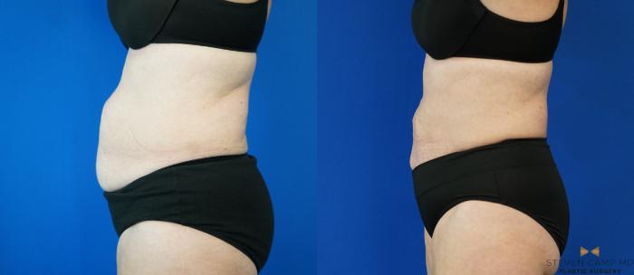 Before & After CoolSculpting Case 197 View #3 View in Fort Worth, Texas