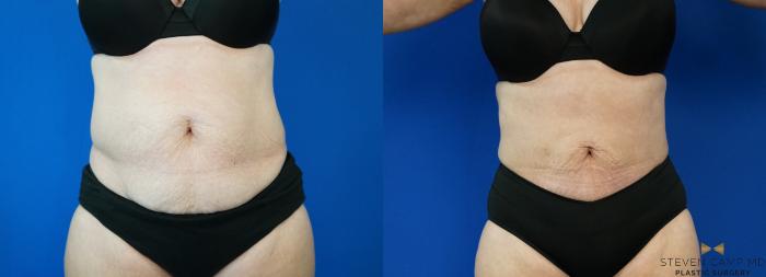 Before & After CoolSculpting Case 197 View #5 View in Fort Worth, Texas