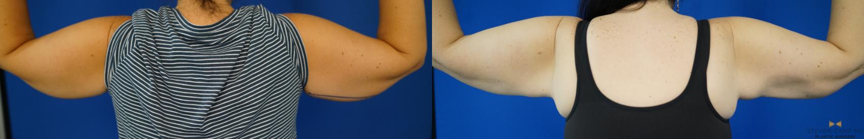 Before & After CoolSculpting Case 355 Back View in Fort Worth, Texas