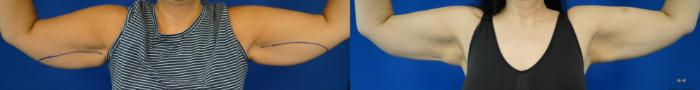 Before & After CoolSculpting Case 355 Front View in Fort Worth, Texas