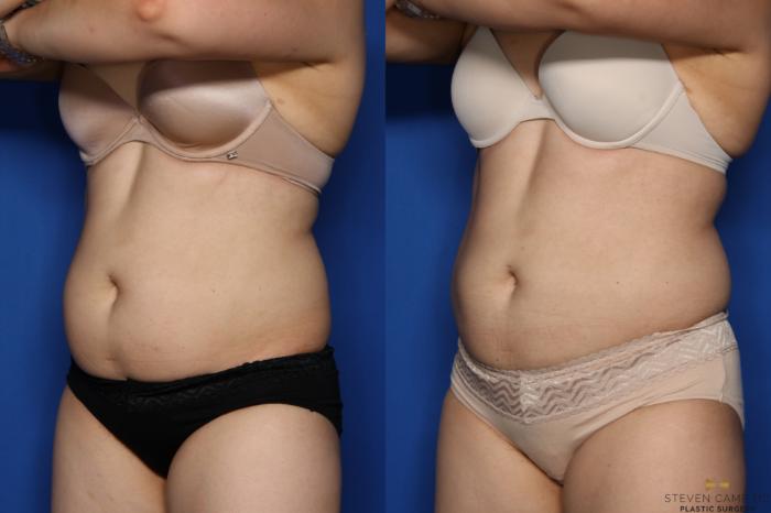 Before & After CoolSculpting Case 497 Left Oblique View in Fort Worth, Texas