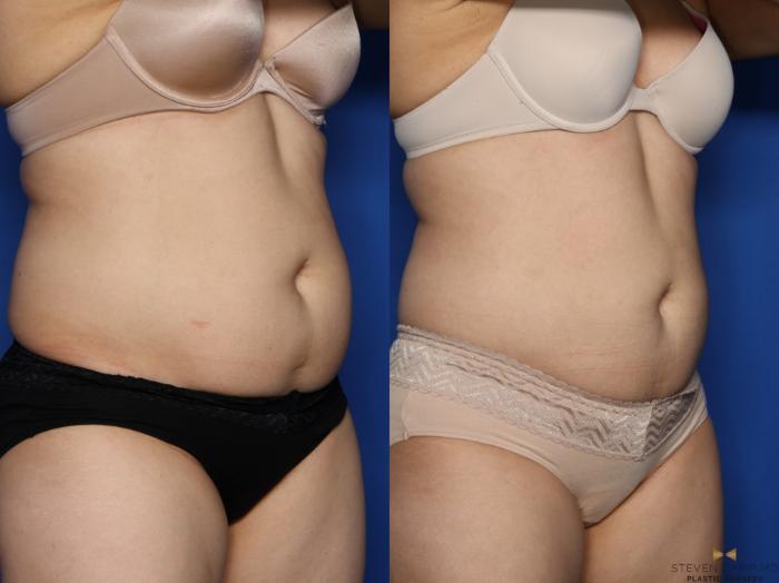 Before & After CoolSculpting Case 497 Right Oblique View in Fort Worth, Texas