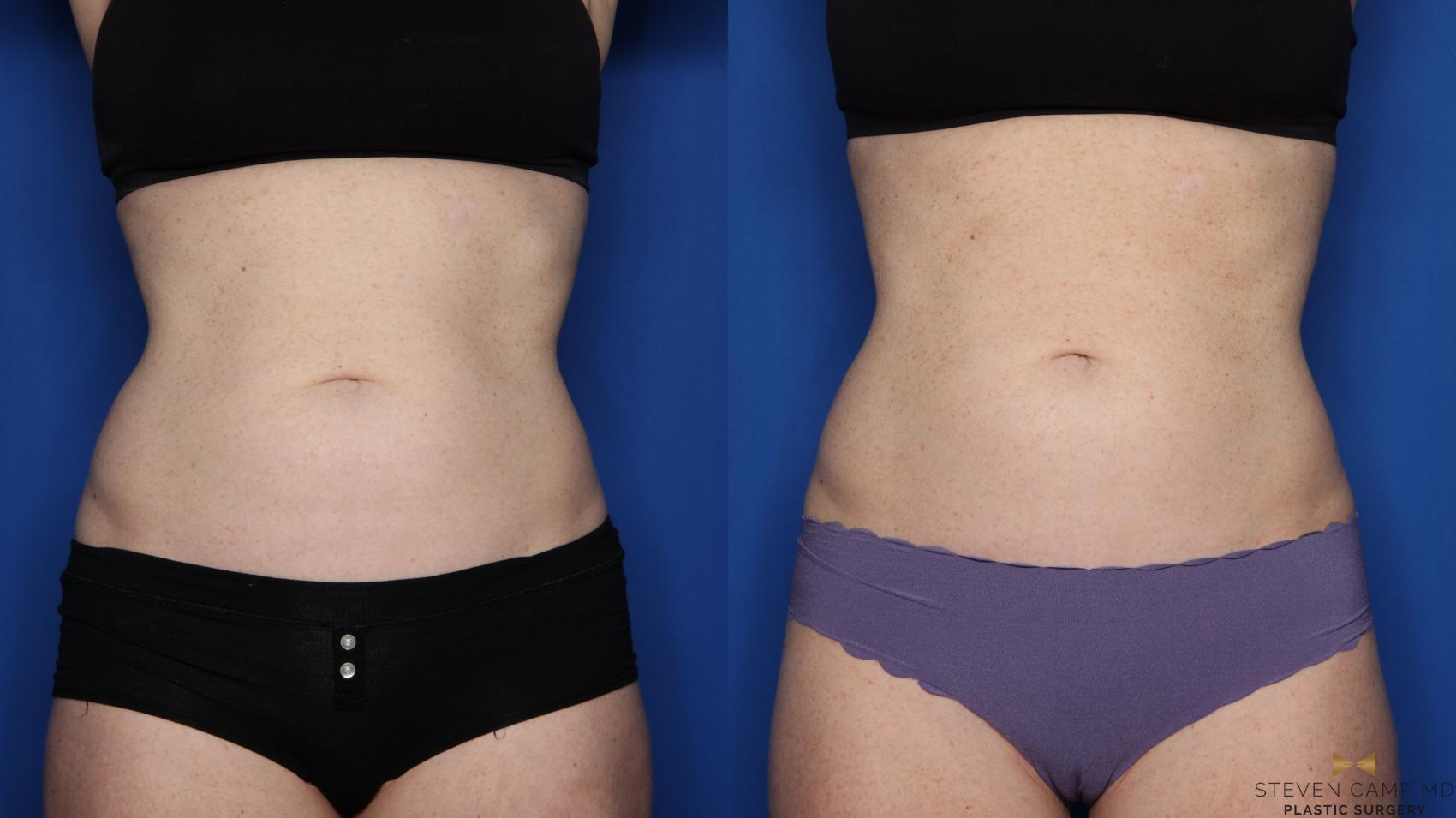 Before & After CoolSculpting Case 498 Front View in Fort Worth, Texas