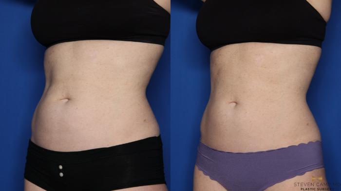 Before & After CoolSculpting Case 498 Left Oblique View in Fort Worth, Texas