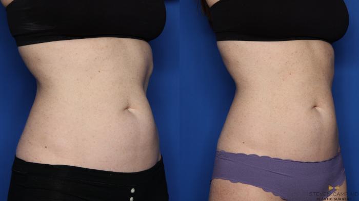 Before & After CoolSculpting Case 498 Right Oblique View in Fort Worth, Texas