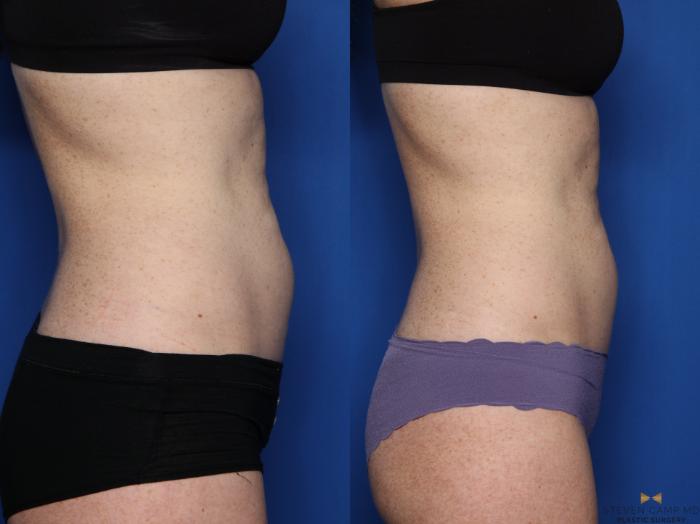 Before & After CoolSculpting Case 498 Right Side View in Fort Worth, Texas