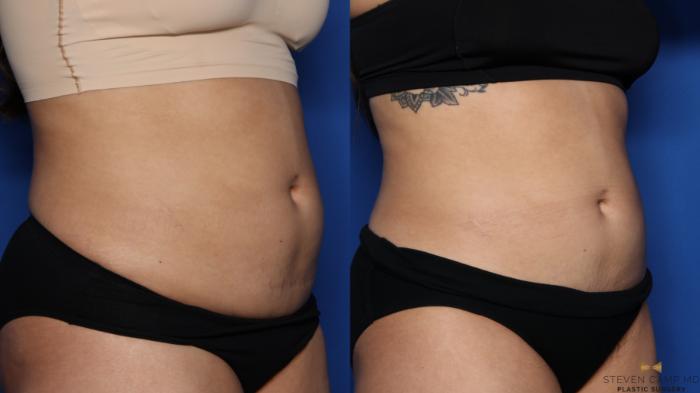 Before & After CoolSculpting Case 526 Right Oblique View in Fort Worth, Texas