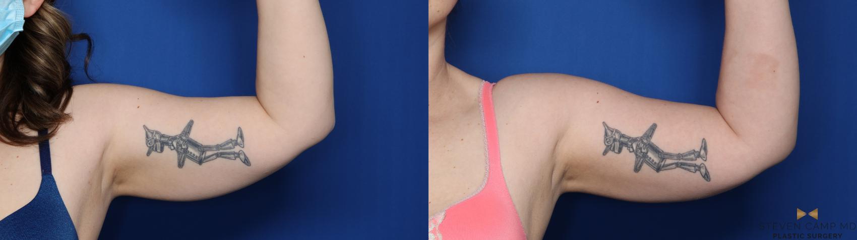 Before & After CoolSculpting Case 527 L Frontal View in Fort Worth, Texas