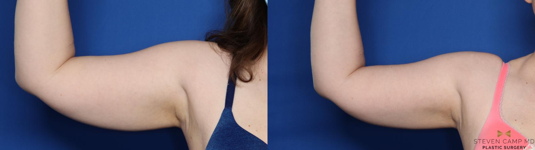 Before & After CoolSculpting Case 527 Left Side View in Fort Worth, Texas