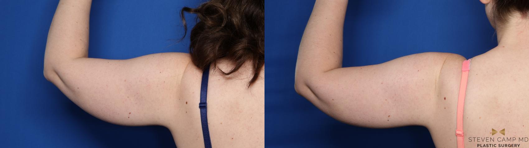 Before & After CoolSculpting Case 527 R Back View in Fort Worth, Texas