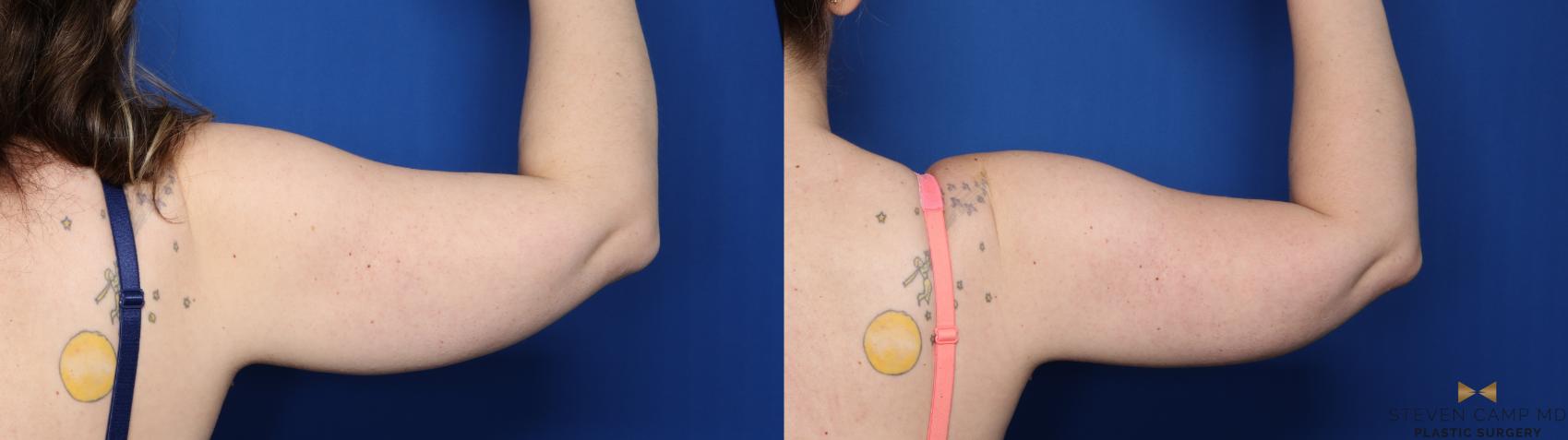 Before & After CoolSculpting Case 527 Right Side View in Fort Worth, Texas