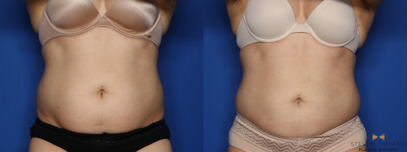 Before & After CoolSculpting Case 528 Front View in Fort Worth, Texas