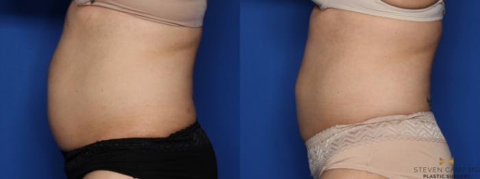 Before & After CoolSculpting Case 528 Left Side View in Fort Worth, Texas