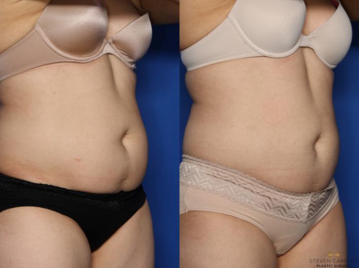 Before & After CoolSculpting Case 528 Right Oblique View in Fort Worth, Texas