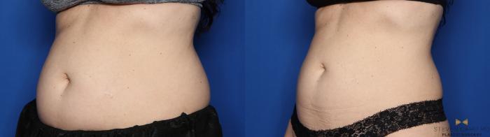 Before & After CoolSculpting Case 536 Left Oblique View in Fort Worth, Texas