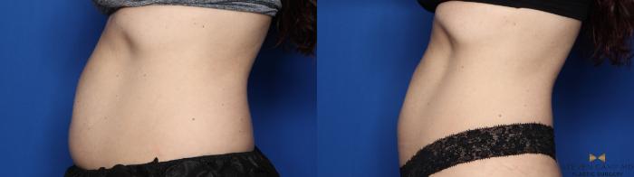 Before & After CoolSculpting Case 536 Left Side View in Fort Worth, Texas