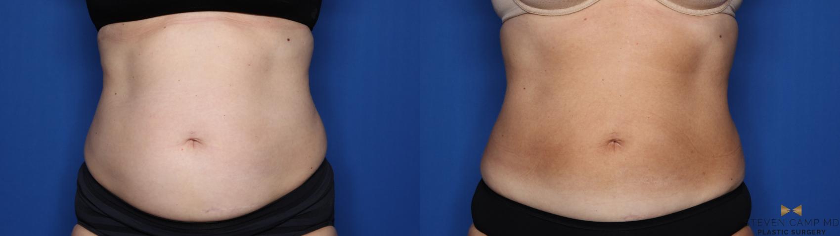 Before & After CoolSculpting Case 558 Front View in Fort Worth, Texas