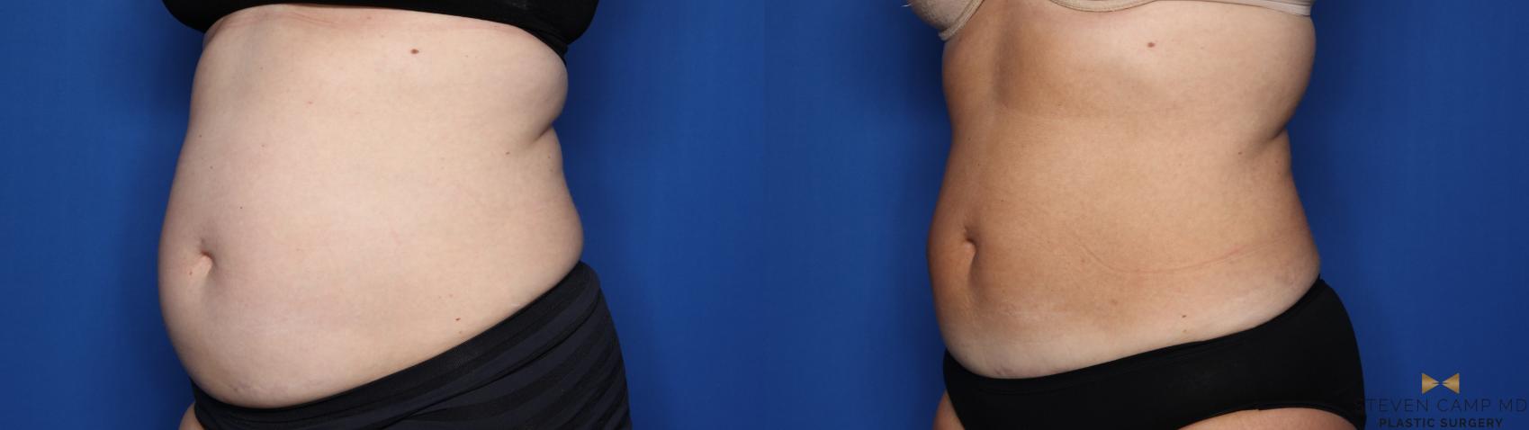 Before & After CoolSculpting Case 558 Left Oblique View in Fort Worth, Texas