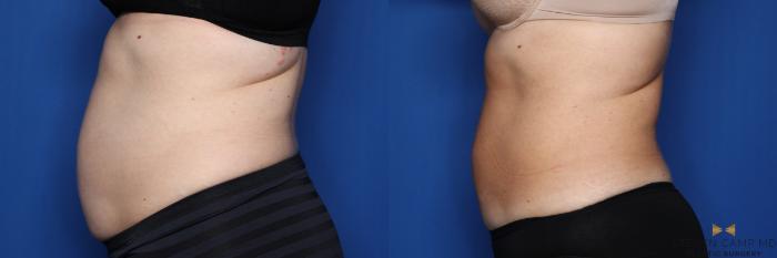 Before & After CoolSculpting Case 558 Left Side View in Fort Worth, Texas