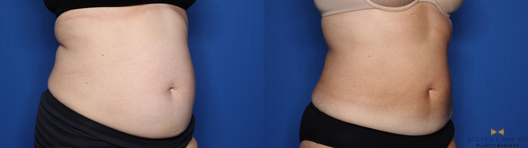 Before & After CoolSculpting Case 558 Right Oblique View in Fort Worth, Texas