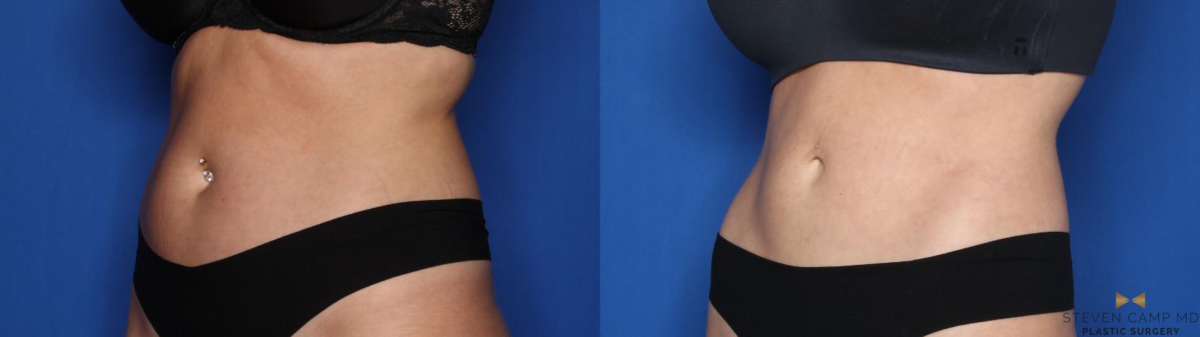 Before & After CoolSculpting Case 559 Left Oblique View in Fort Worth, Texas
