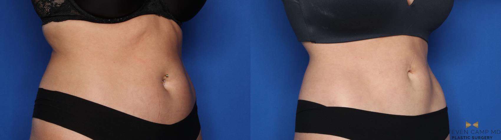 Before & After CoolSculpting Case 559 Right Oblique View in Fort Worth, Texas