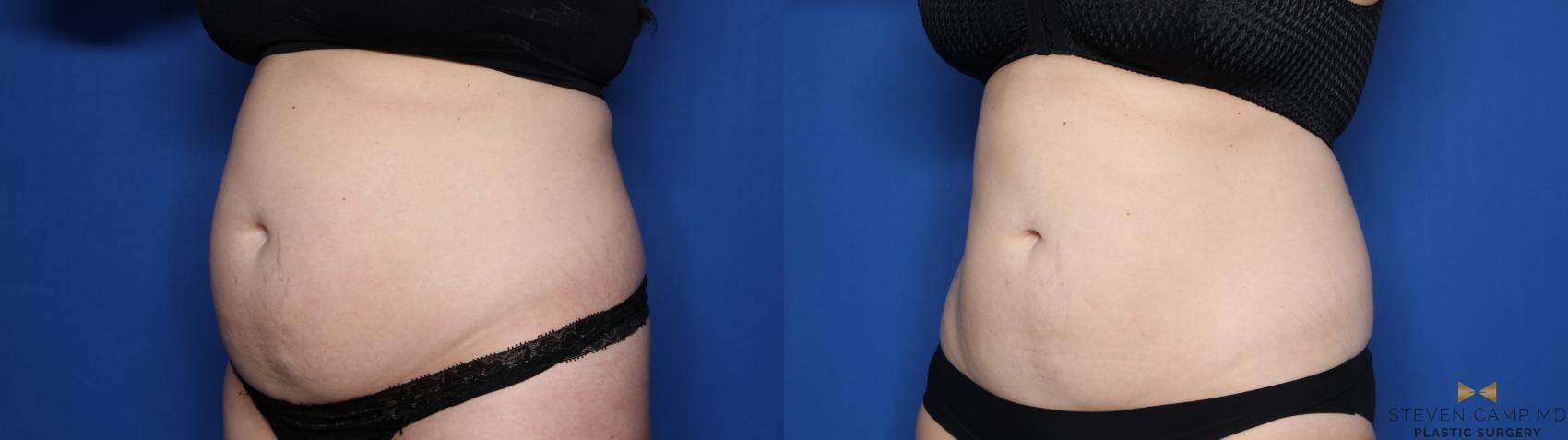 Before & After CoolSculpting Case 560 Left Oblique View in Fort Worth, Texas