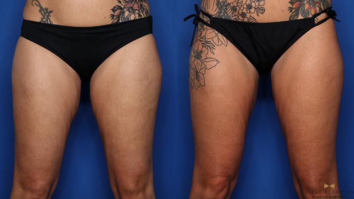 Before & After CoolSculpting Case 561 Front View in Fort Worth, Texas