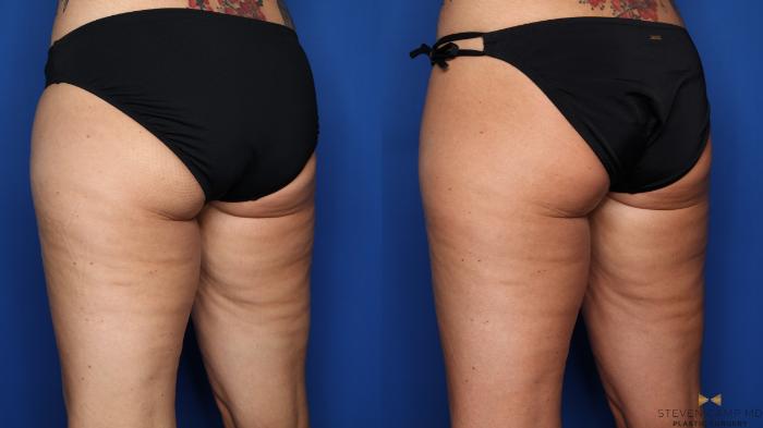 Before & After CoolSculpting Case 561 Left Oblique View in Fort Worth, Texas