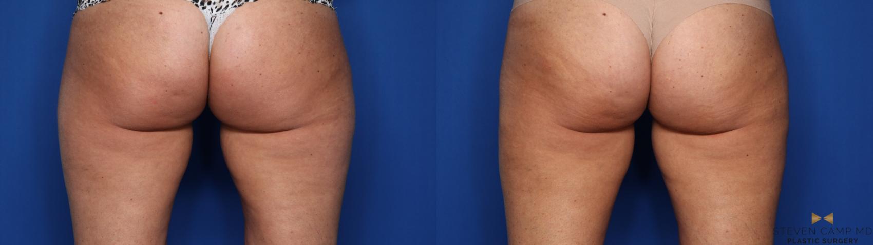 Before & After CoolSculpting Case 563 Back View in Fort Worth, Texas