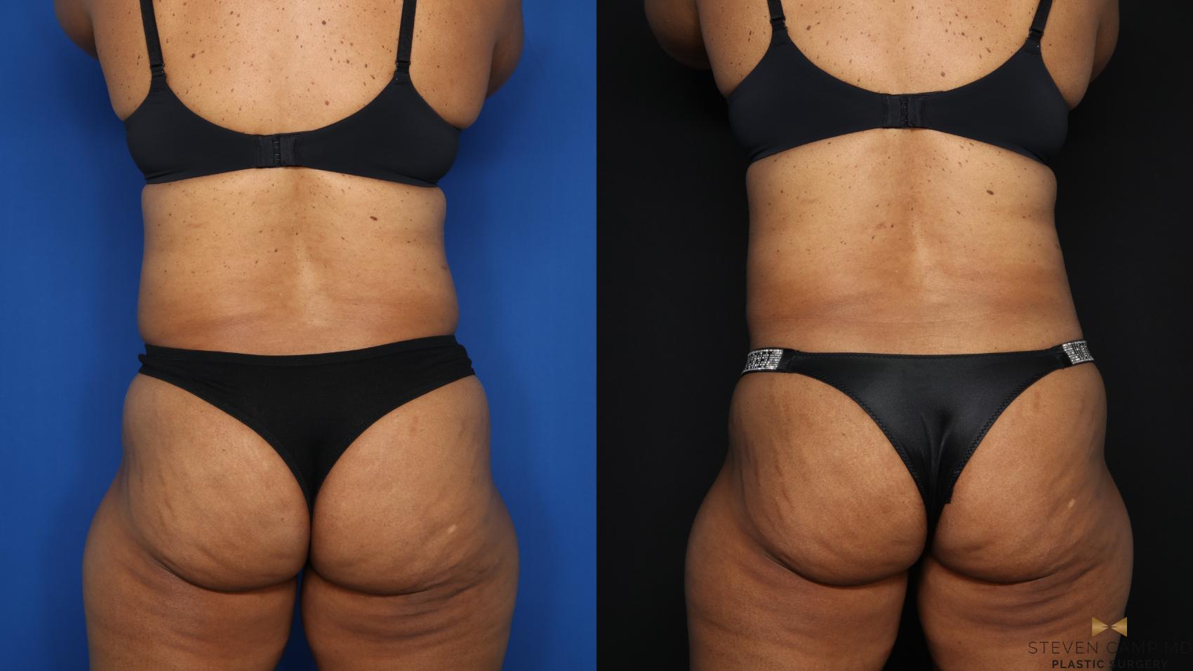 Before & After CoolSculpting Case 590 Back View in Fort Worth, Texas