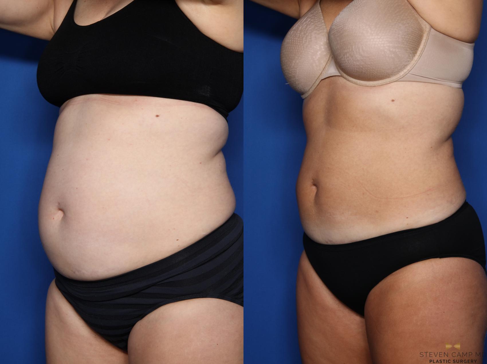 Before & After CoolSculpting Case 594 Left Oblique View in Fort Worth, Texas